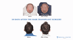 The Patient Journey in Hair Transplantation