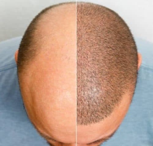 Frequently Asked Questions in Hair Transplant