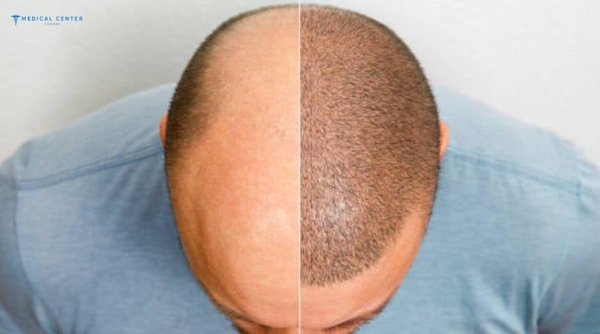 Frequently Asked Questions in Hair Transplant