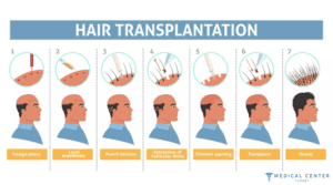 The Patient Journey in Hair Transplantation