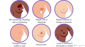 breast cancer in turkey