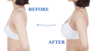 Is Boob Job Painful? 