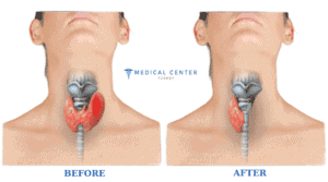 Complex Treatment for Thyroid Cancer 