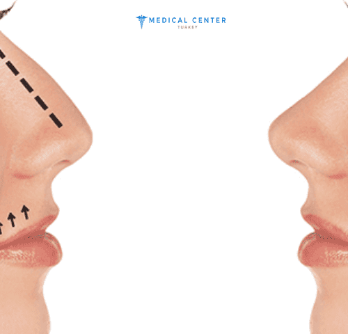 Rhinoplasty Cost in Turkey