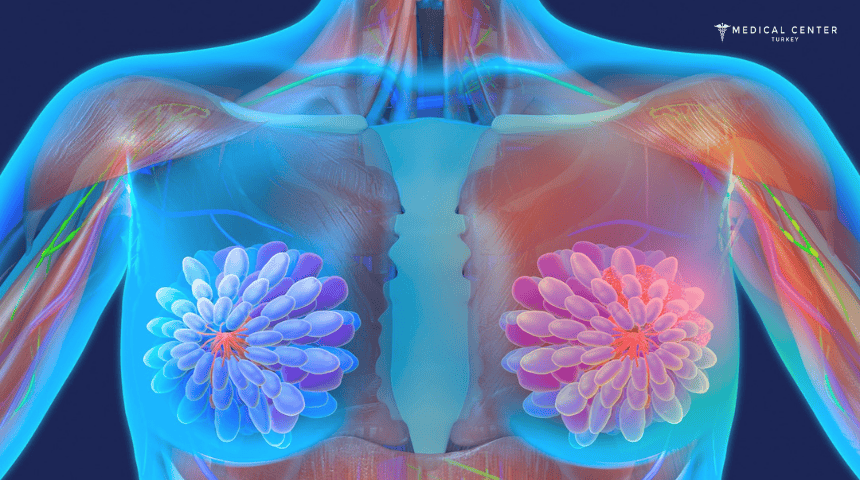 Gland Therapy for Breast Cancer