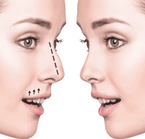 How To Make The Nose Smaller Naturally? How To Make The Nose Smaller Naturally?