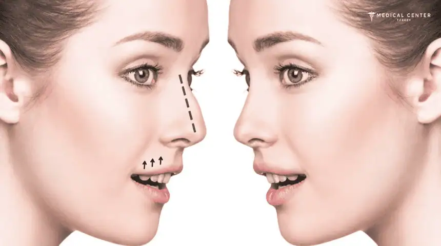 How To Make The Nose Smaller Naturally?