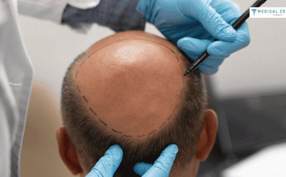 Why Do People Want To Have Hair Transplant?