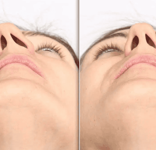 Septoplasty in Turkey