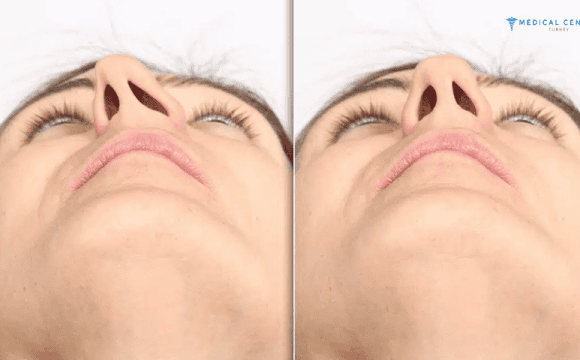 Septoplasty in Turkey