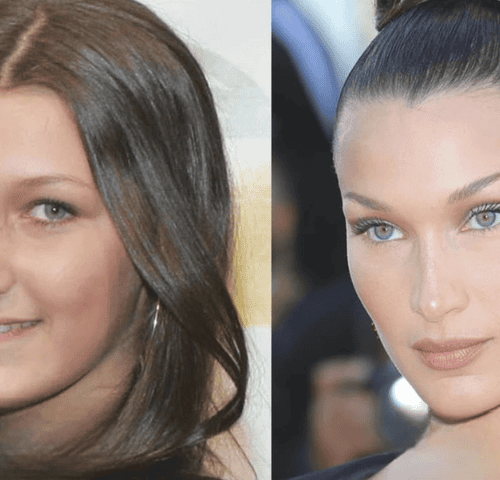 Bella Hadid’s Rhinoplasty Surgery