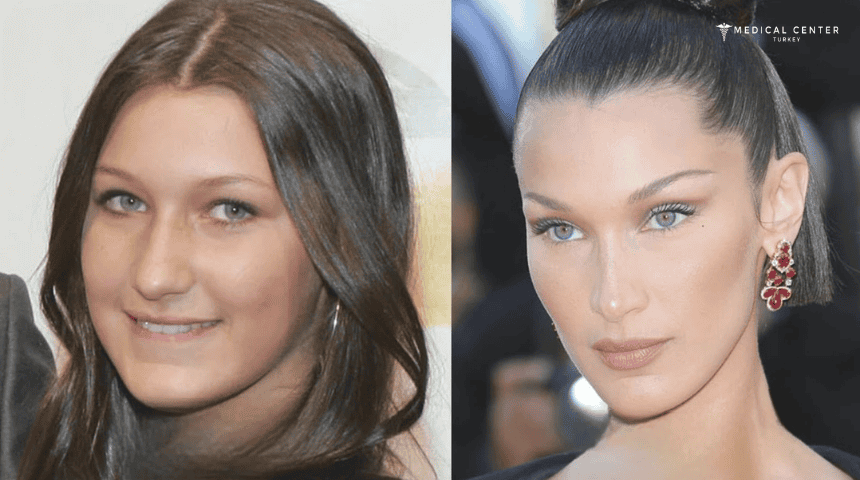 Bella Hadid’s Rhinoplasty Surgery