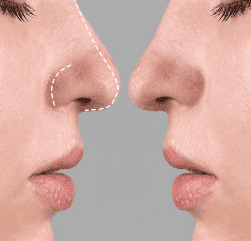 Top 5 Cheapest Countries for Rhinoplasty (Nose Job) in the World