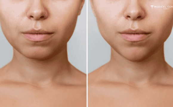 Bichectomy Surgery in Turkey