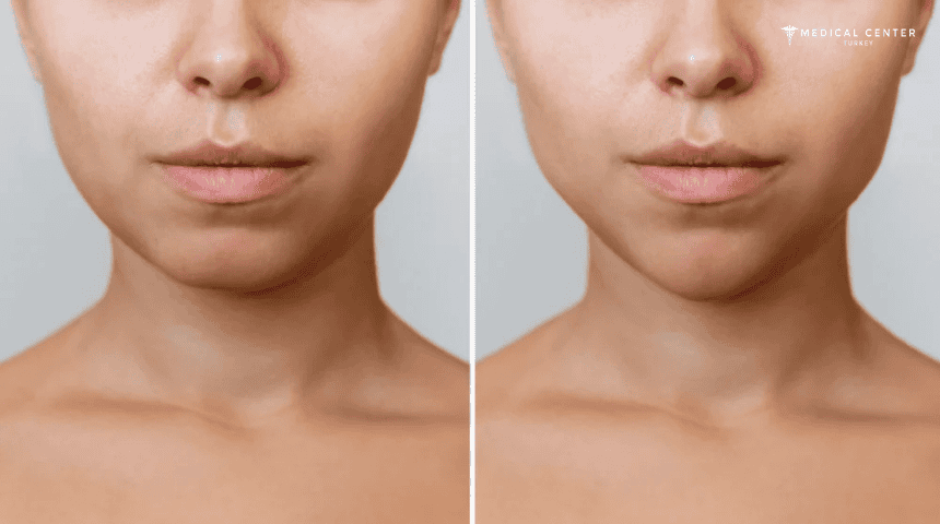 Bichectomy Surgery in Turkey Bichectomy Surgery in Turkey