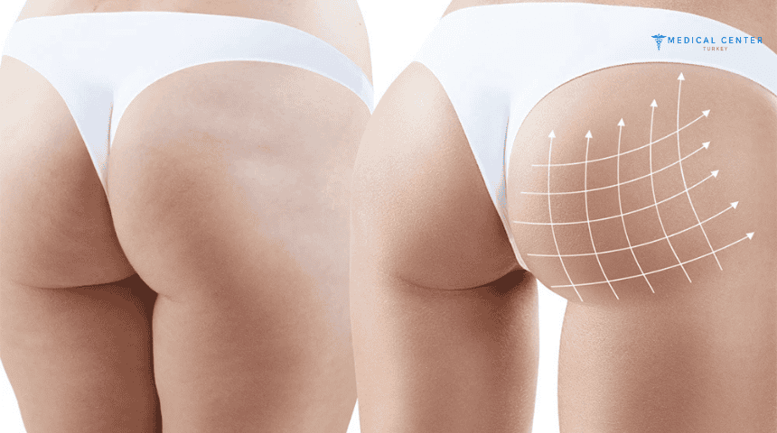 Is Butt Lift Painful? Is Butt Lift Painful?