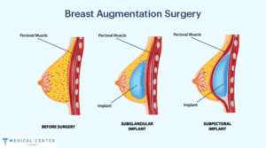 HOW MUCH IS BOOB JOB IN TURKEY 2024?
