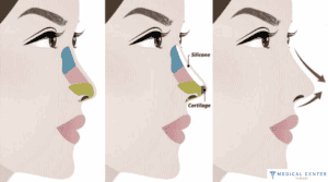 How To Make The Nose Smaller ?