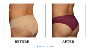 How much is Butt Lift in Turkey 2024! (3)