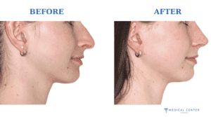 How Much is Nose Job in Turkey?