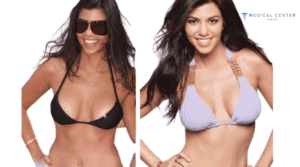 Which Celebrities got Breast Implants?