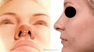 How Much is Nose Job in Turkey?