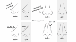  How Much is Nose Job in Turkey?
