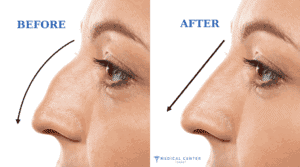 Is Turkey the Best Destination for Rhinoplasty?