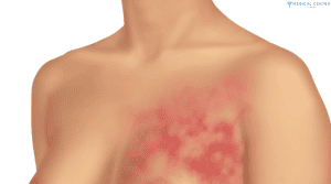 breast cancer in turkey