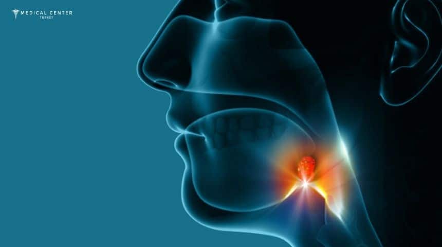 Radiotherapy for Throat Cancer