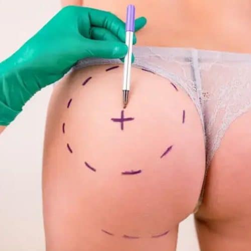 How much is Butt Lift in Turkey?