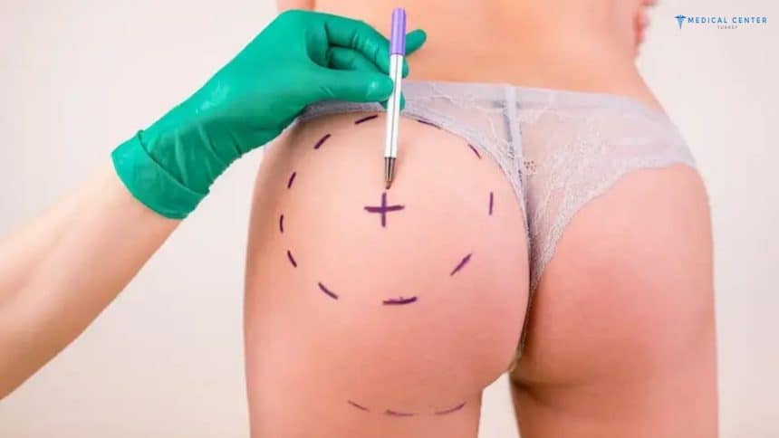 How much is Butt Lift in Turkey?