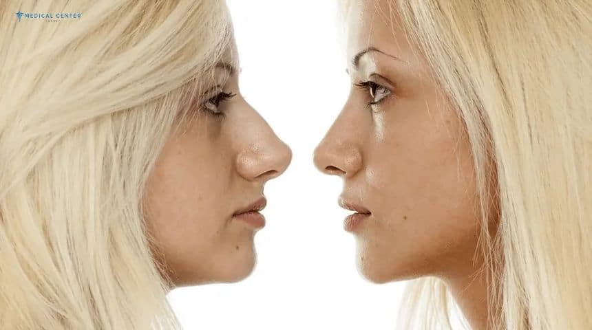 Cheapest Countries For Nose Job