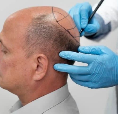 18 Things to Avoid After a Hair Transplant Procedure