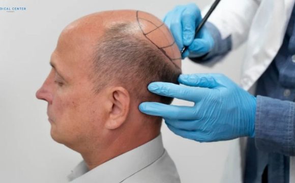 18 Things to Avoid After a Hair Transplant Procedure