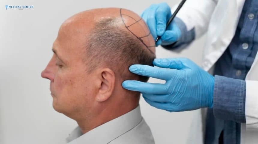 18 Things to Avoid After a Hair Transplant Procedure