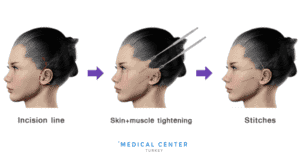 Is Facelift Painful 1