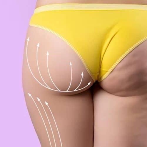 BBL Healing Time in Turkey