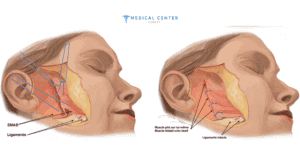 how much is a facelift in turkey 