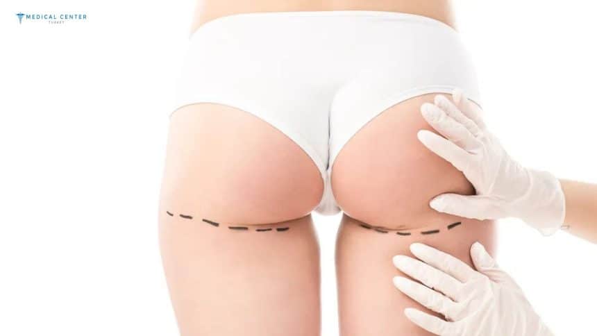 Which is the Best Hospital for Butt Lift in Turkey?