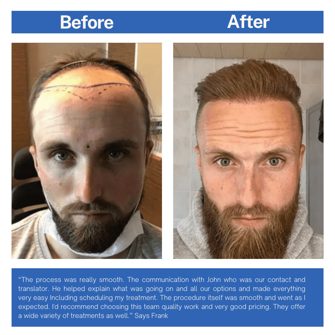 Hair Transplant Before and After Turkey