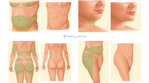 Is Liposuction Painful 