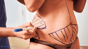 Is Liposuction Painfull 