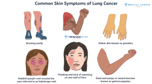 What are the Symptoms of Cancer 