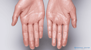 Botox for Hand Sweat 