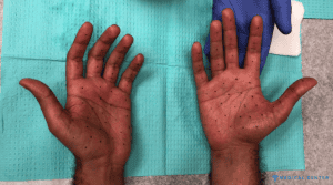 Botox for Hand Sweat 