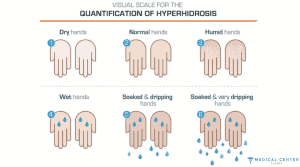 Botox for Hand Sweat 