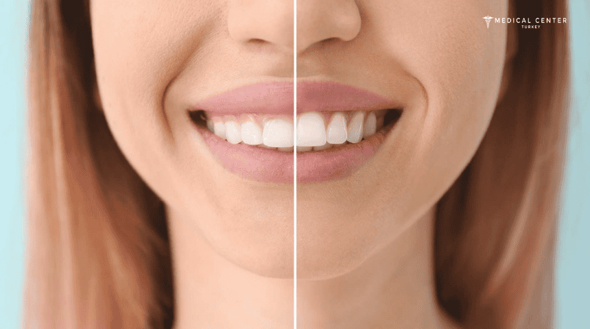 Gum Surgery in Turkey Gum Surgery in Turkey