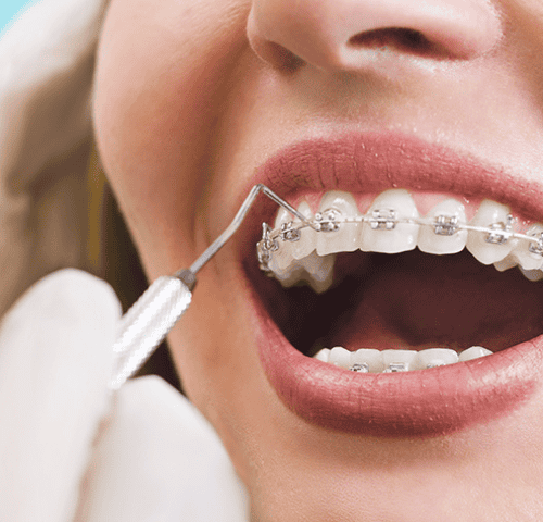 Orthodontic Treatments in Turkey Orthodontic Treatments in Turkey