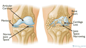 Athlete Meniscus Repair in Turkey 